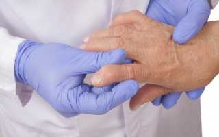 Реактивный артрит у мужчин: причины развития, симптомы, диагностика, методы лечения