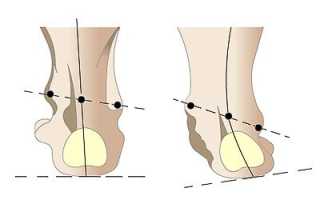 Ортопедические стельки при варусной и вальгусной деформации стопы