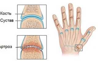 Болит средний и безымянный палец на правой или левой руке: причины боли