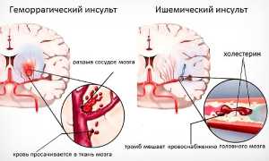 Ишемический инсульт головного мозга в пожилом возрасте: прогноз и продолжительность жизни